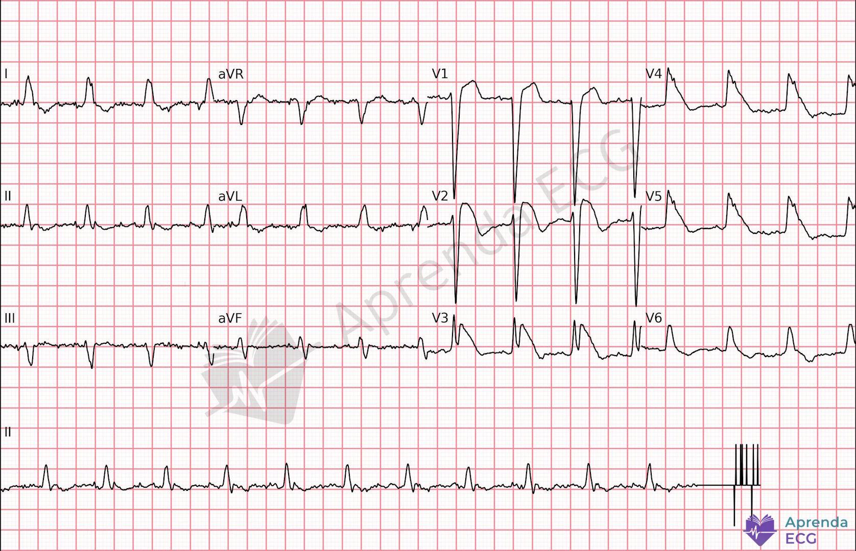 ECG with shark fin sign characterized by massive ST elevation forming a triangular complex