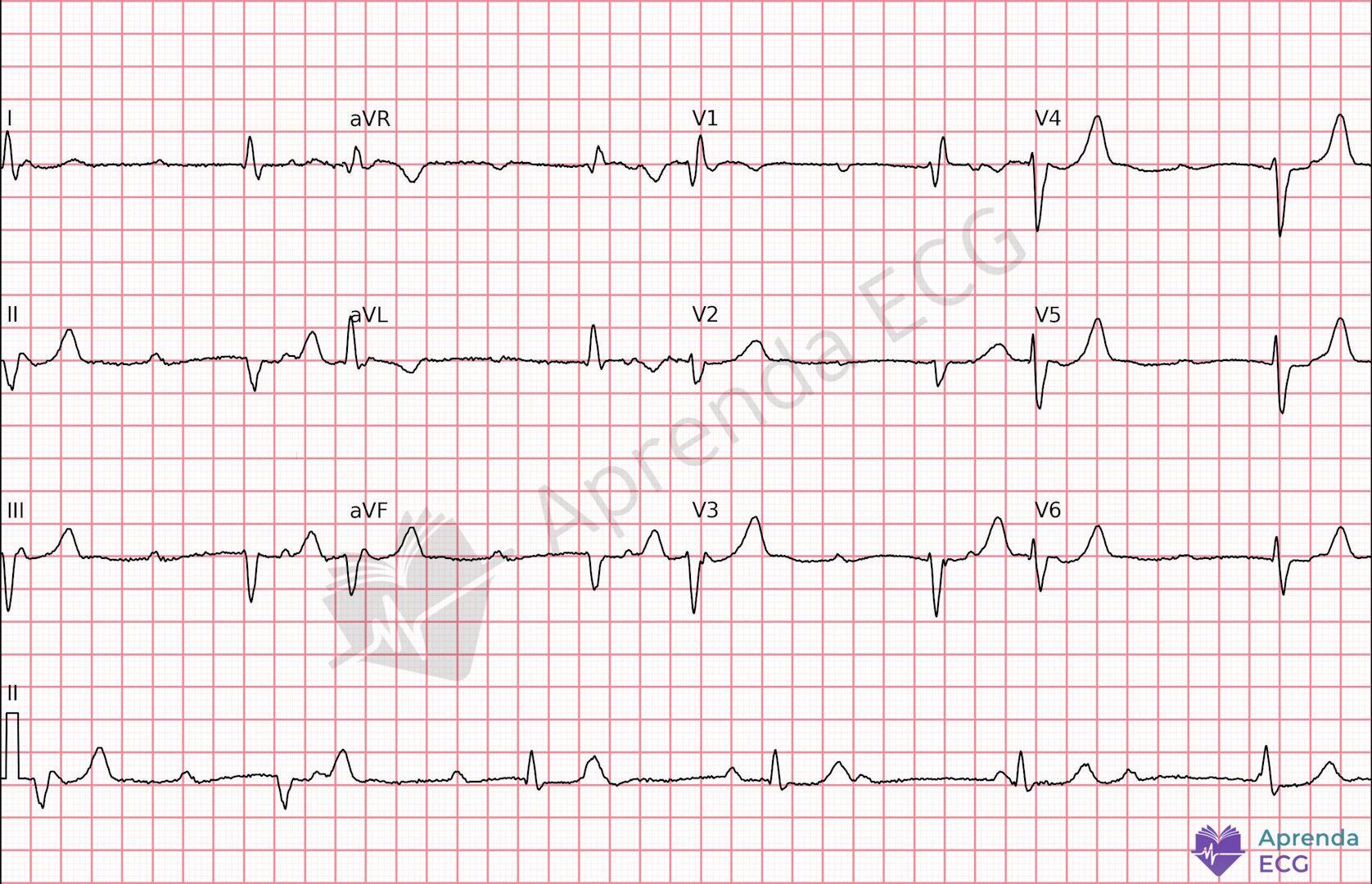 ECG with complete atrioventricular block showing atrioventricular dissociation between P waves and QRS complexes