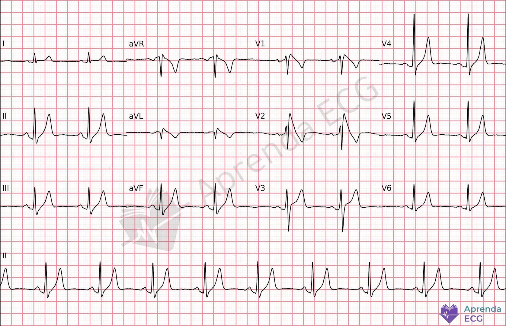 ECG with type 1 Brugada pattern showing coved ST elevation in V1 and V2