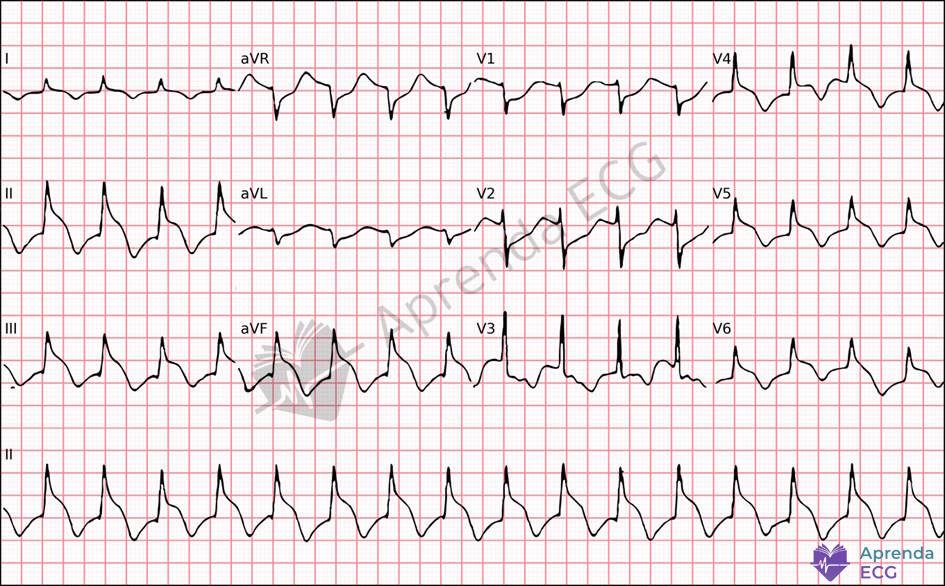 ECG with spiked helmet sign characterized by abrupt ST-segment elevation associated with a critical extracardiac condition