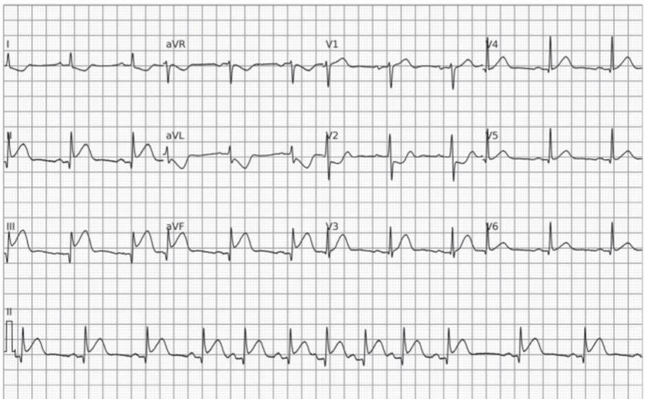 Electrocardiograma con ondas T primarias negativas e infradesnivel del ST en DI, aVL y V2