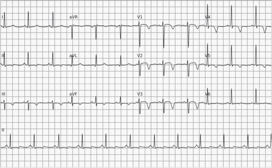 Electrocardiograma con ondas T de reperfusión invertidas en derivaciones inferiores y anteriores