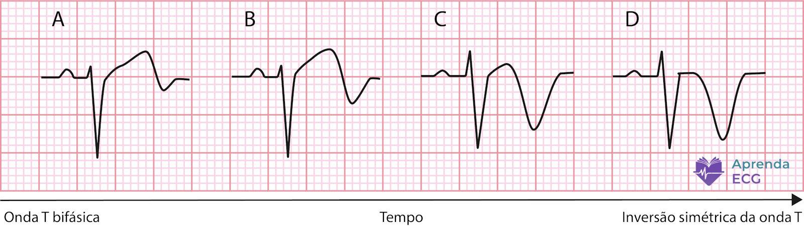 Evolución temporal electrocardiográfica de la inversión simétrica de la onda T en la reperfusión