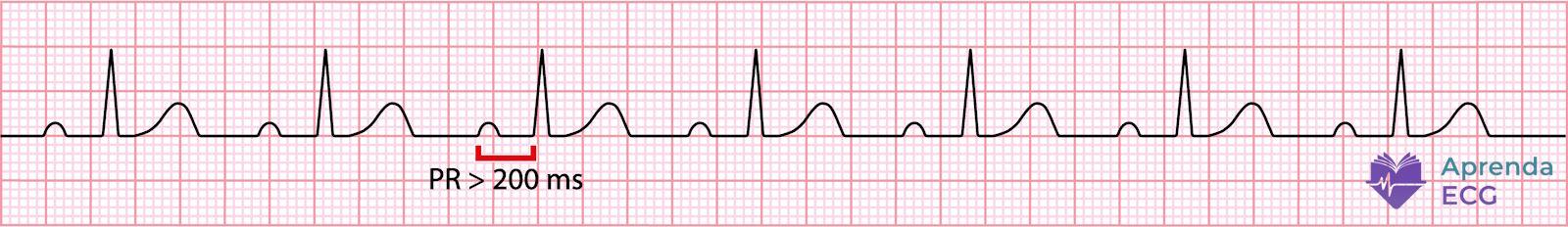 Electrocardiogram showing first-degree atrioventricular block with a prolonged PR interval