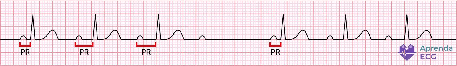 Electrocardiogram showing second-degree atrioventricular block type 1 with progressive PR prolongation