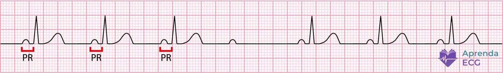 Electrocardiogram showing second-degree atrioventricular block type 2 with sudden conduction failure