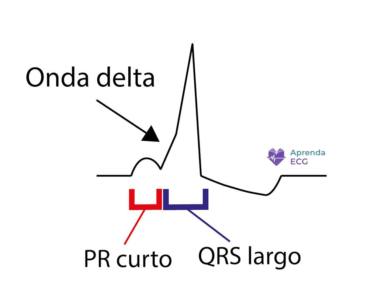 Electrocardiogram with ventricular pre-excitation showing a delta wave