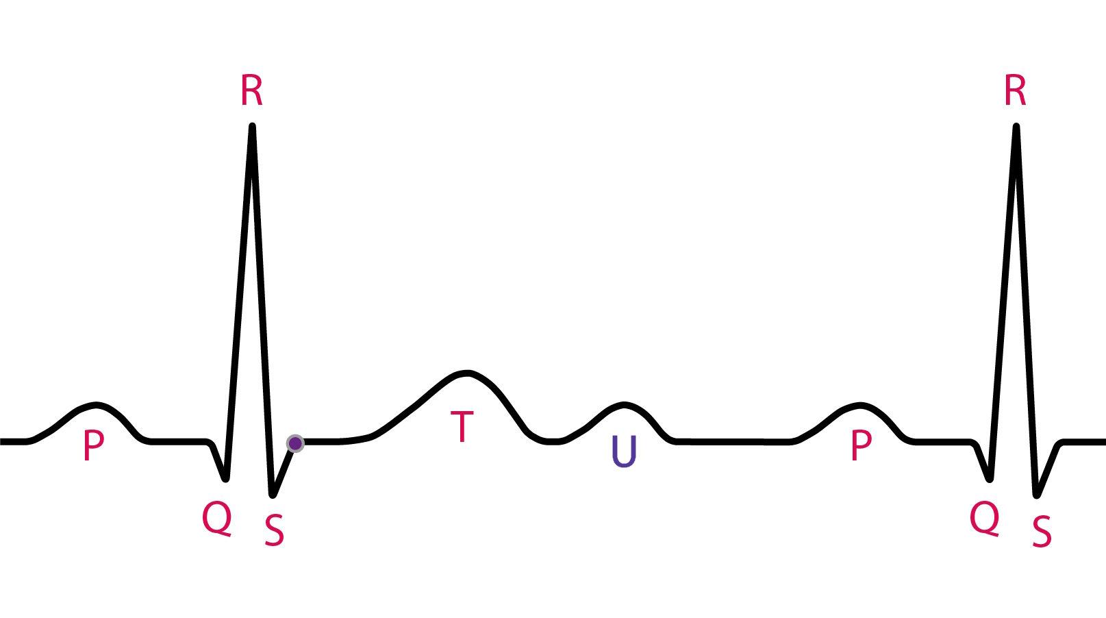 Electrocardiogram showing a U wave after the T wave