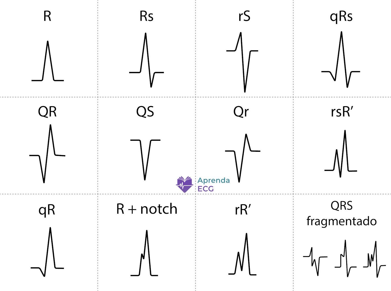 Diagram illustrating the nomenclature of QRS complex deflections on the electrocardiogram