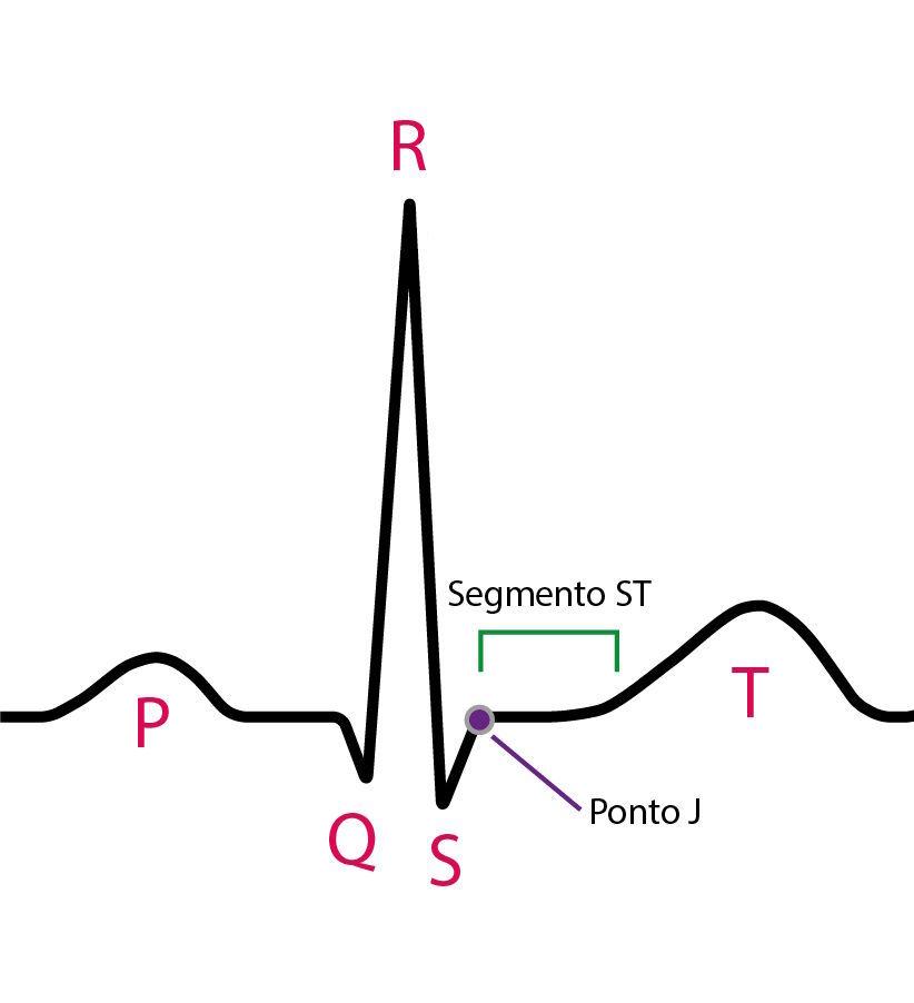 Diagram illustrating the ST segment on the electrocardiogram