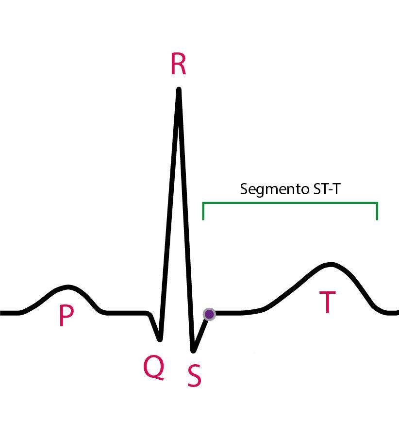 Representation of the T wave on the electrocardiogram