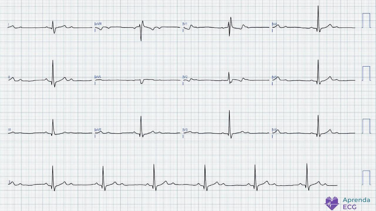 Electrocardiograma que muestra bloqueo auriculoventricular 2:1 asociado a bloqueo de rama derecha