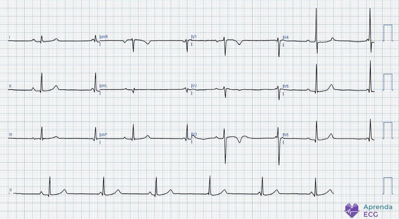Electrocardiogram showing atrioventricular dissociation with similar atrial and ventricular rates and a variable PR interval