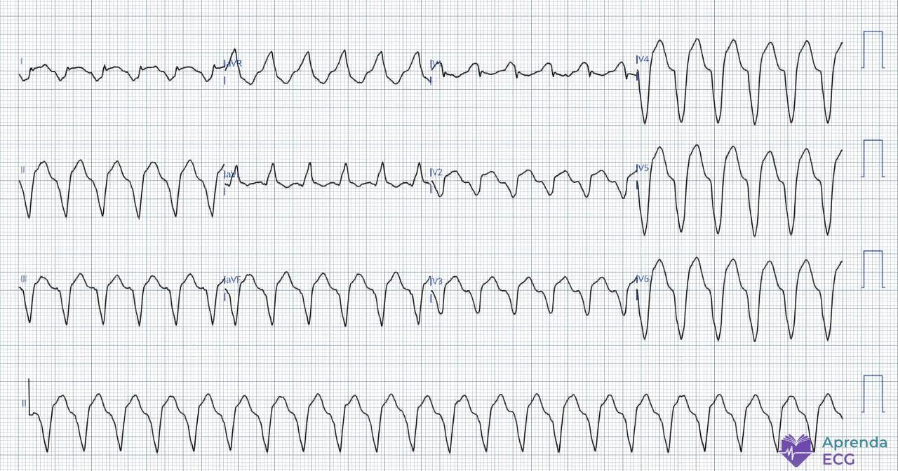 Electrocardiogram showing a regular wide QRS tachycardia consistent with ventricular tachycardia