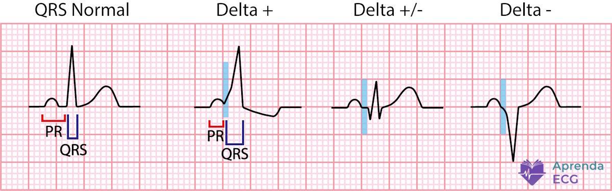 Delta wave on the electrocardiogram characterizing ventricular pre-excitation