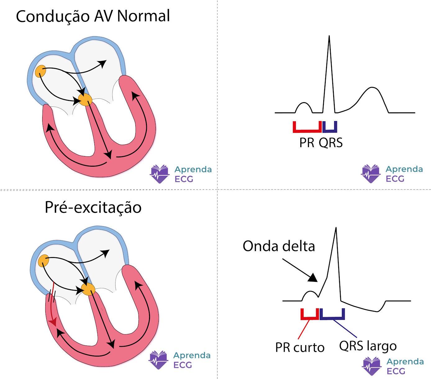 Delta wave on the ECG showing ventricular pre-excitation via an accessory pathway