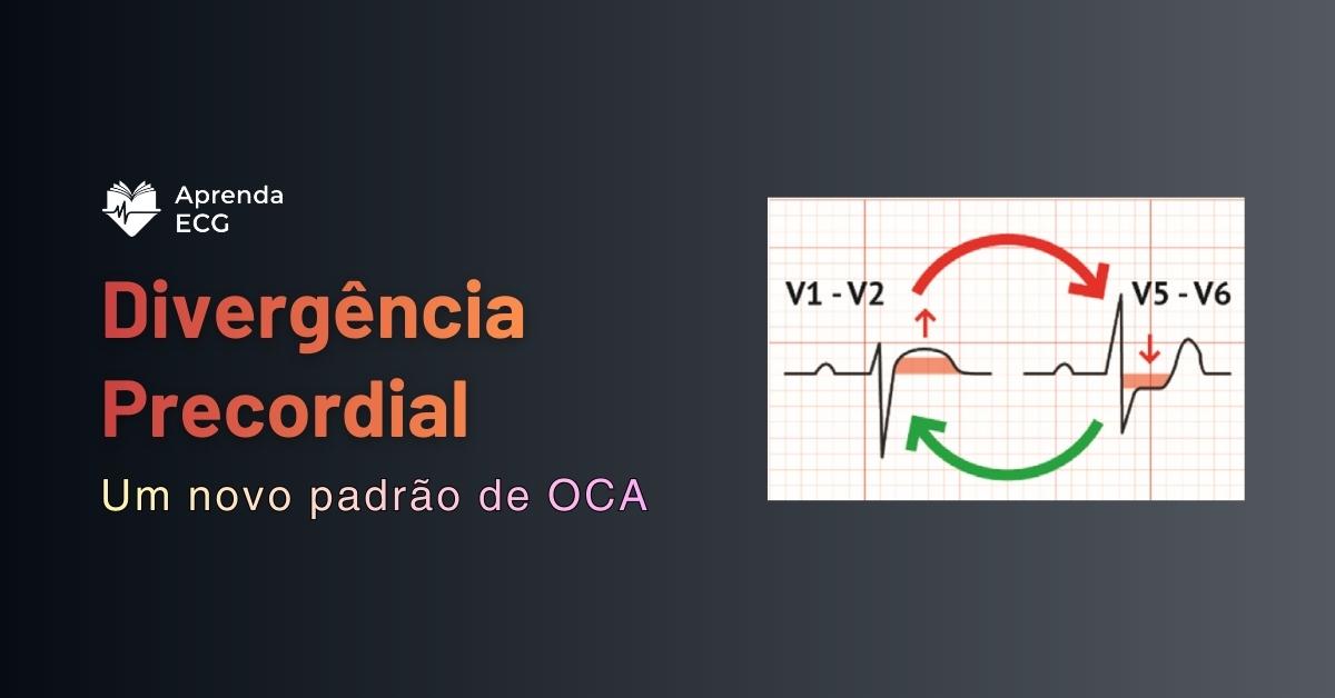 Divergência Precordial: um novo padrão de OCA