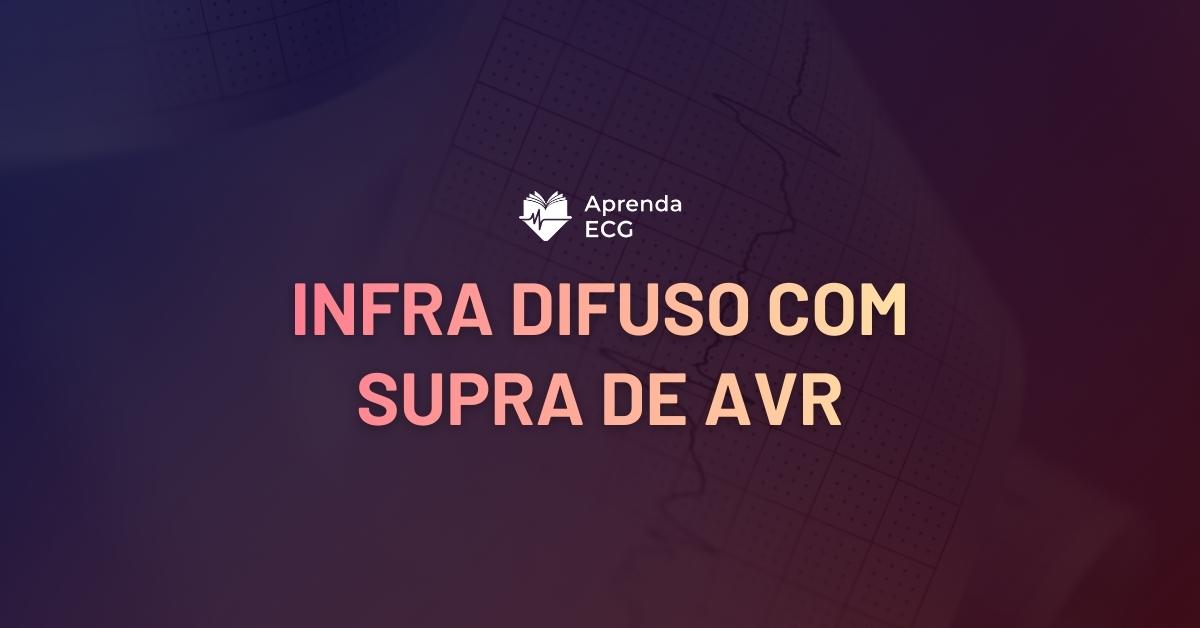 Infradesnivelamento Difuso com Supradesnivelamento de aVR