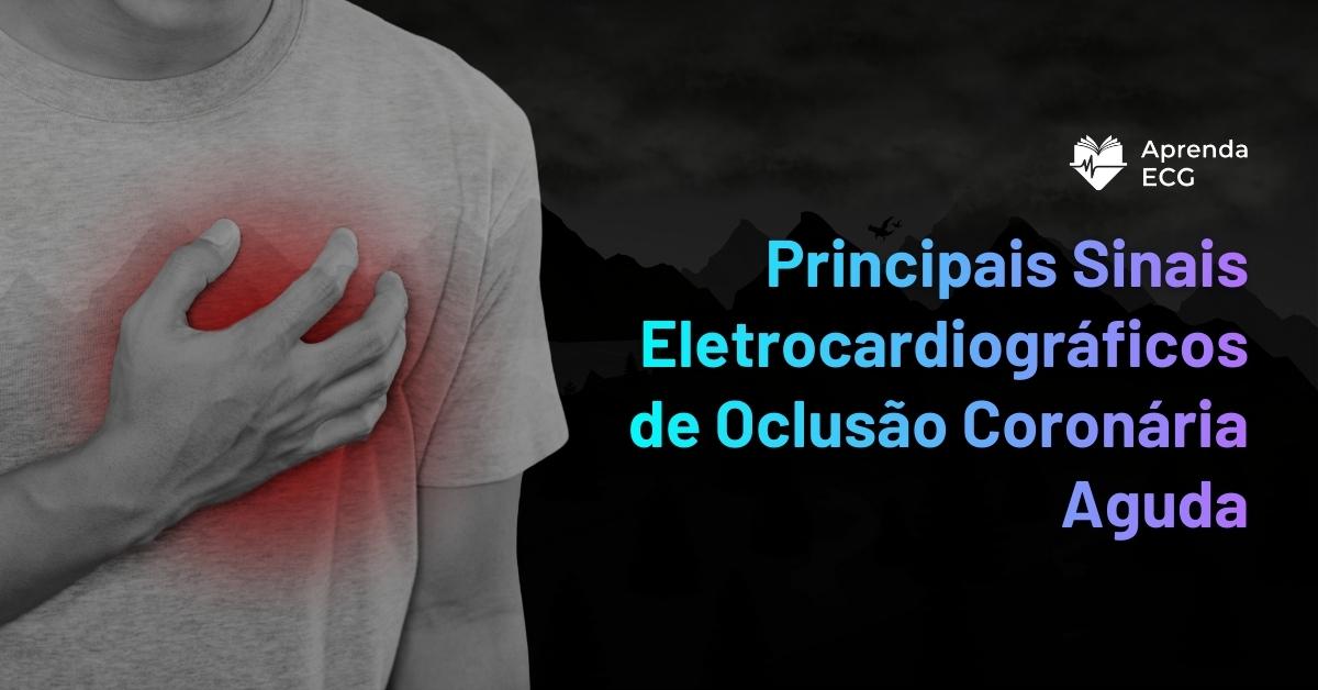 Principais Sinais Eletrocardiográficos de Oclusão Coronária Aguda