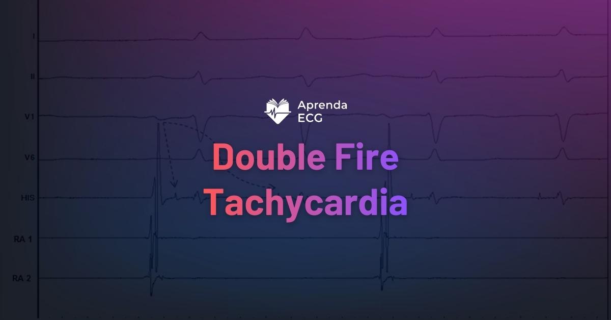 Double Fire Tachycardia