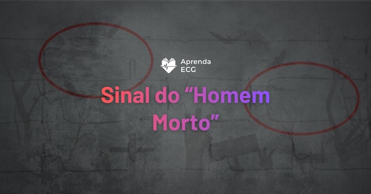 O Sinal do Homem Morto no ECG: uma curiosidade visual no IAM inferior