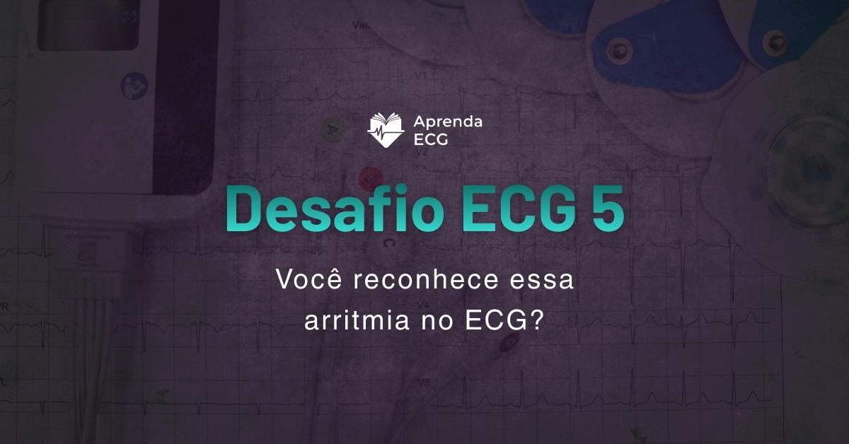 Desafio ECG 5: Você reconhece essa arritmia no ECG?