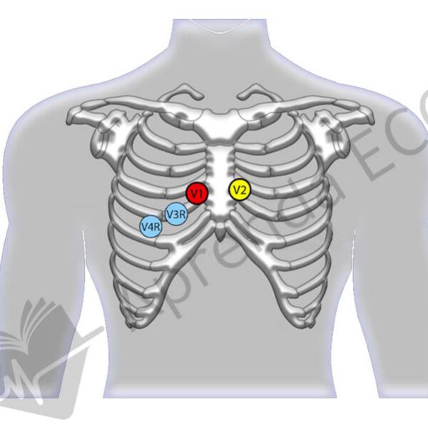 Eletrocardiograma com hipercalemia