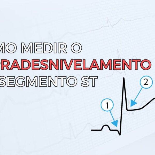 Eletrocardiograma com ritmo atrial ectópico