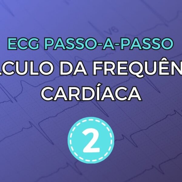 Algoritmo de Brugada para o diagnóstico diferencial entre taquicardia ventricular e taquicardia supraventricular com aberrância de condução
