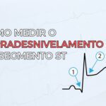 Algoritmo de Basel para o diagnóstico diferencial entre taquicardia ventricular e taquicardia supraventricular com aberrância no eletrocardiograma