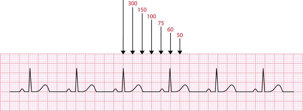 Desenho representando a progressão normal da onda R no eletrocardiograma nas derivações V1 a V6