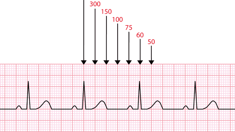 Eletrocardiograma com pré-excitação ventricular e onda delta