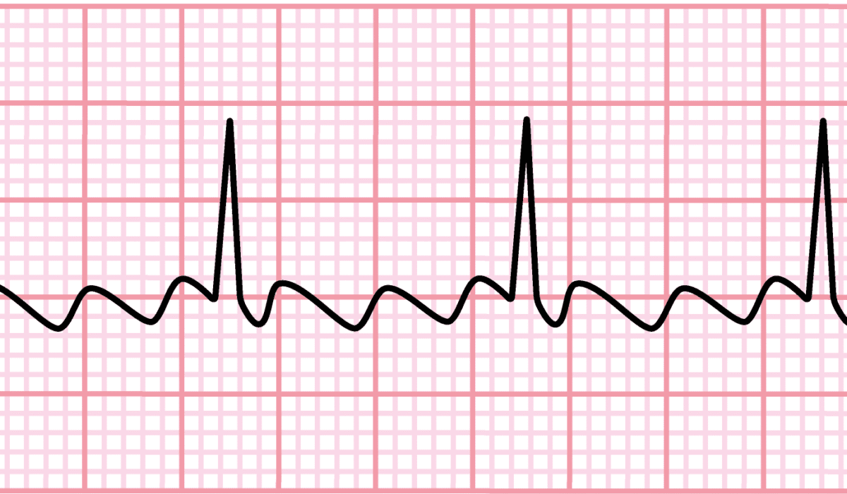 Eletrocardiograma com bloqueio de ramo esquerdo (BRE)