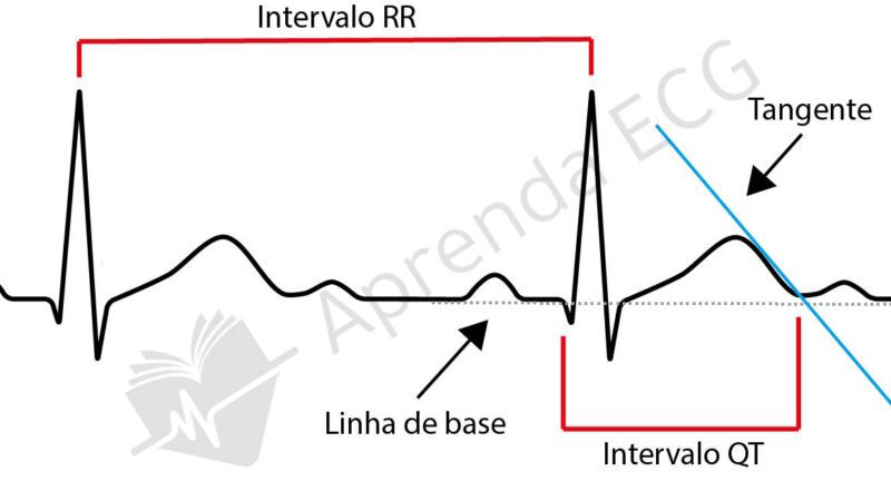 Alterações eletrocardiográficas na hipercalemia