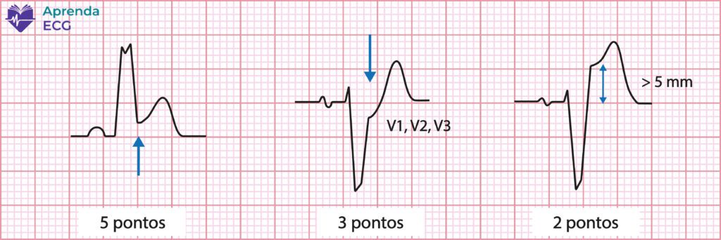 criterios de sgarbossa