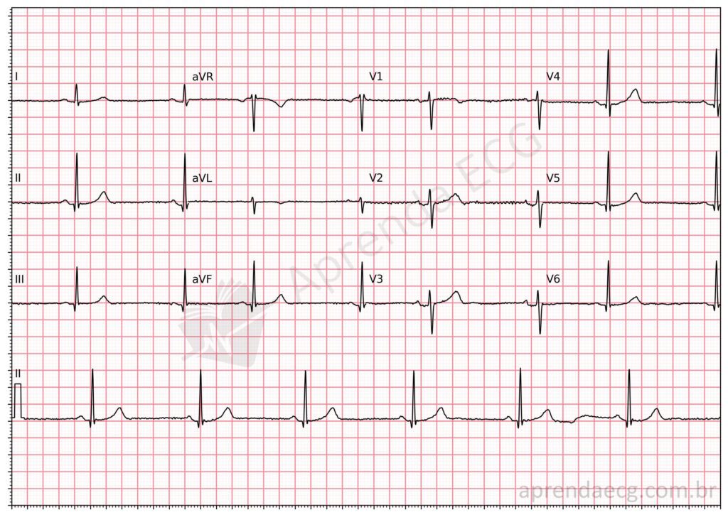 Eletrocardiograma com bradicardia sinusal