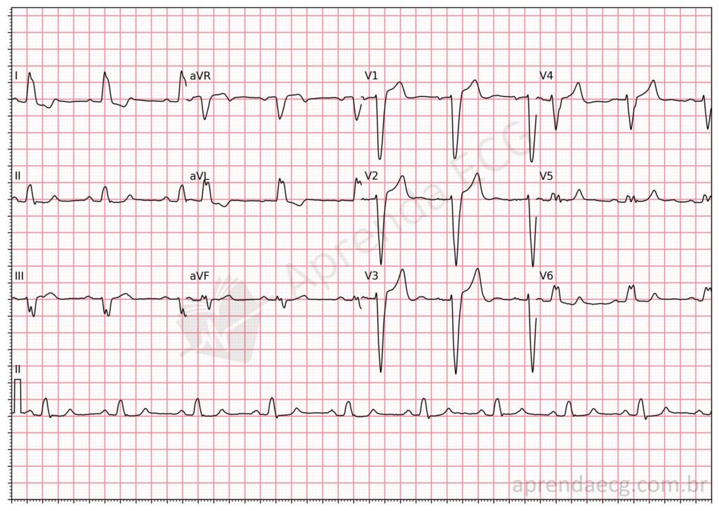Eletrocardiograma com bloqueio de ramo esquerdo