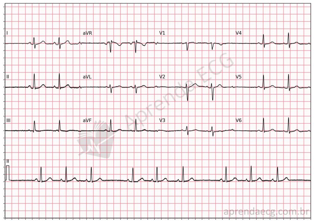 Eletrocardiograma com bloqueio sinoatrial