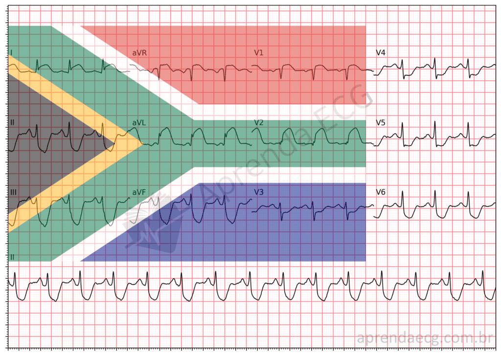 Eletrocardiograma com sinal da bandeira da áfrica do sul e infarto da parede anterior média