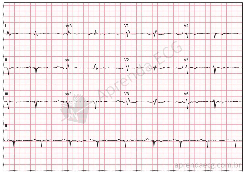 Eletrocardiograma na doença de Chagas
