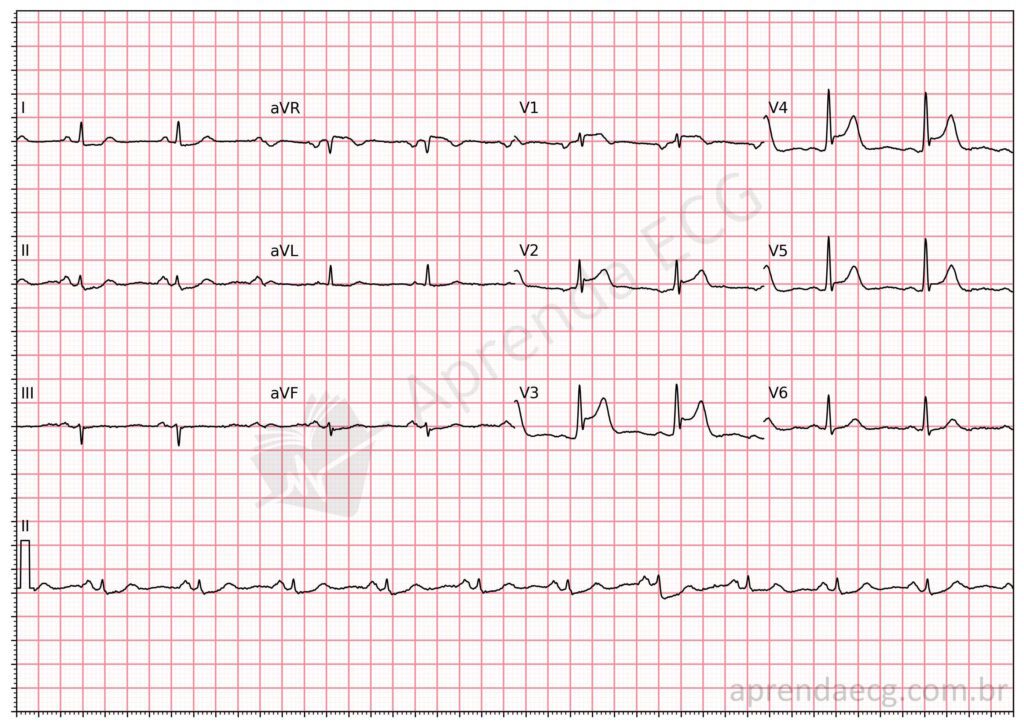 Eletrocardiograma do distorção terminal do QRS