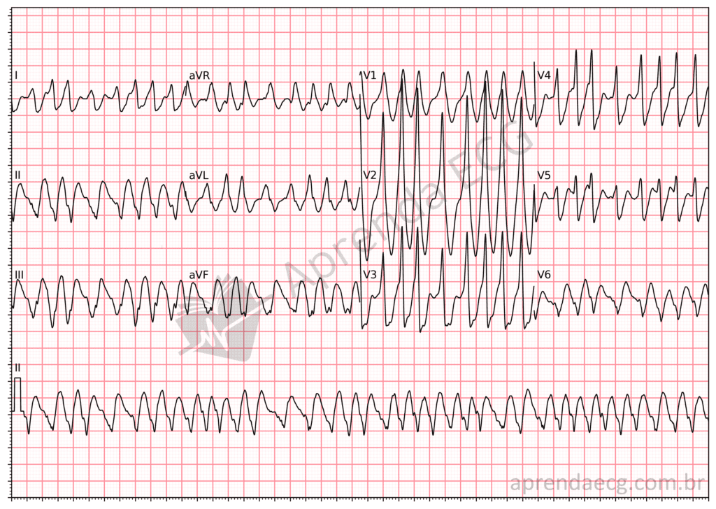 Eletrocardiograma com fibrilação atrial pré-excitada