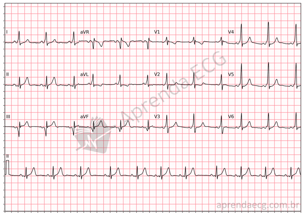 Eletrocardiograma com pré-excitação ventricular