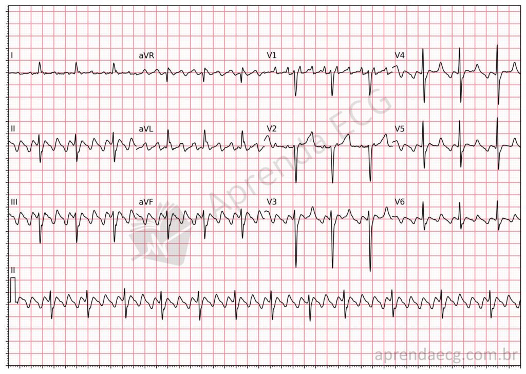 Flutter Atrial Aprenda ECG Flutter Atrial Aprenda ECG