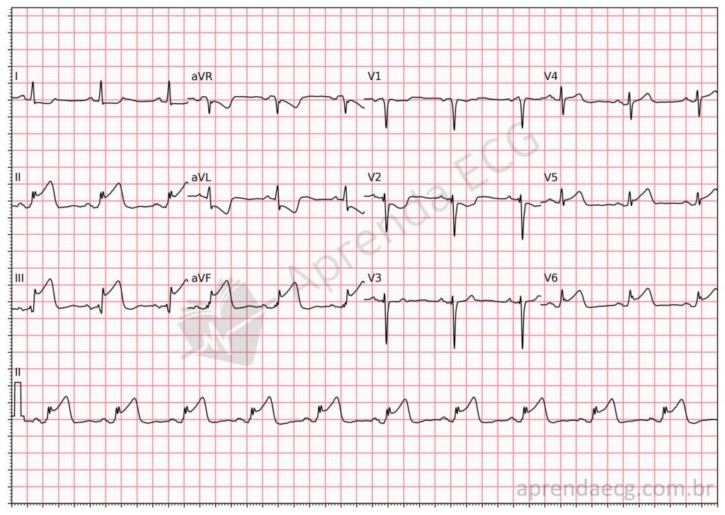 Eletrocardiograma com supradesnivelamento do segmento ST e infarto da parede inferolateral