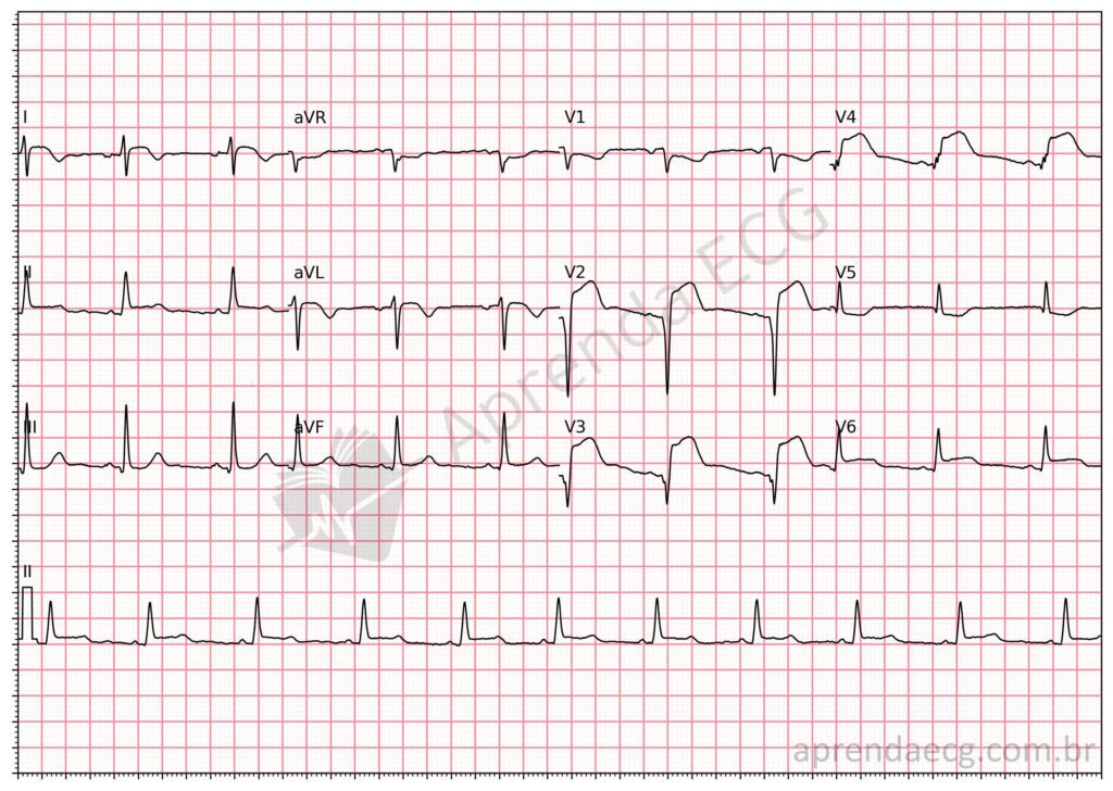 Eletrocardiograma com supradesnivelamento do segmento ST e infarto da parede anterior extensa