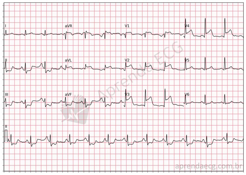 Eletrocardiograma com supradesnivelamento do segmento ST e infarto da parede anterior extensa