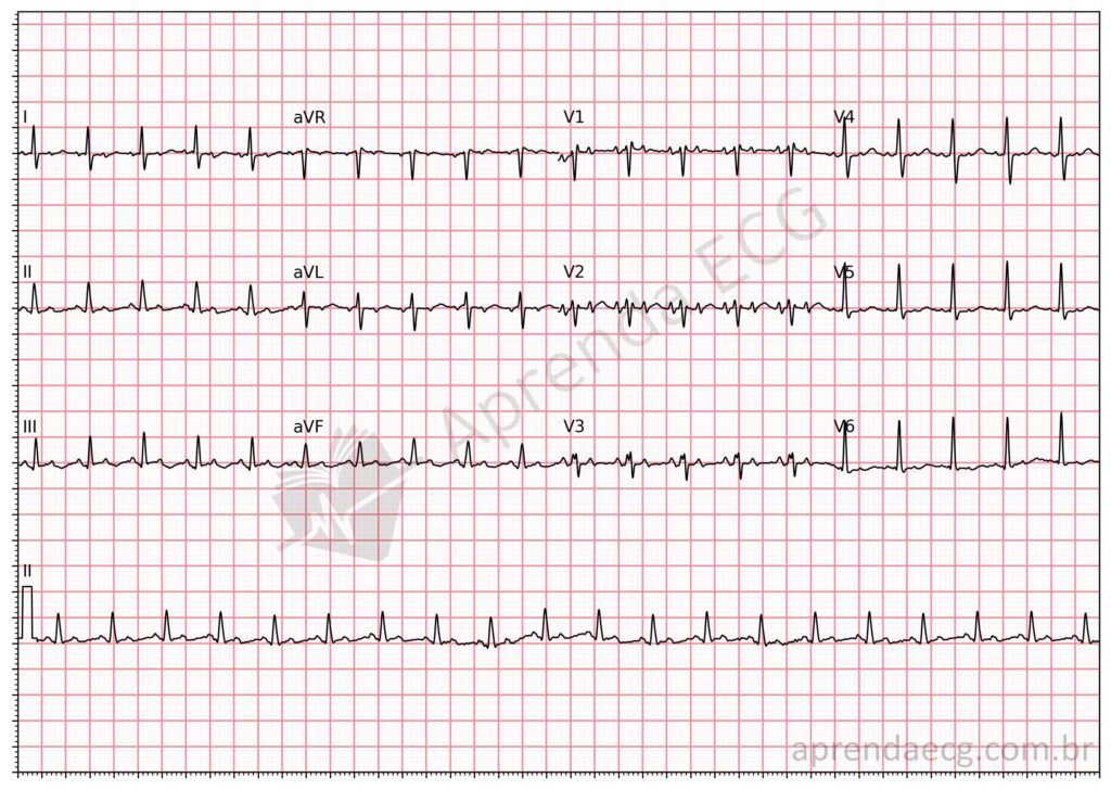 Eletrocardiograma com taquicardia atrial focal