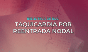 Leia mais sobre o artigo Taquicardia por Reentrada Nodal