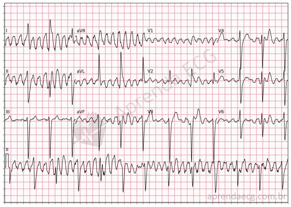 Eletrocardiograma com artefato